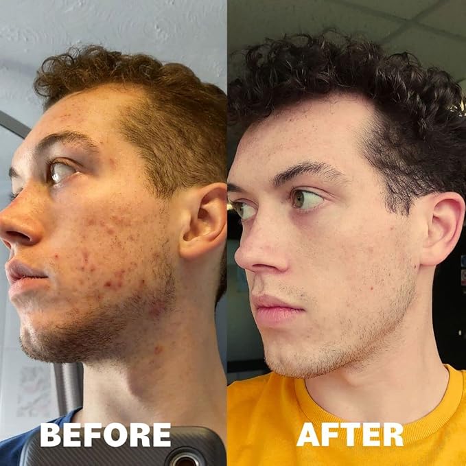 POREFAVOR Acne Supplements – Includes DIM, Zinc + 10 actives targeting the 4 stages of acne development Clear Skin Vitamins for Spots, Blemishes & Oil Control, for Women, Men, & Teens (1 Month Supply)